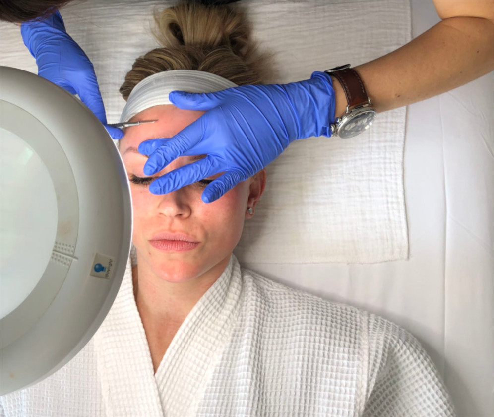 Microneedling For Total Facial Rejuvenation